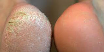 callus-peel-before-and-after